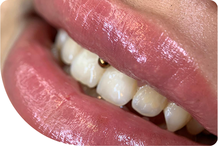teeth with a small golden tooth gem